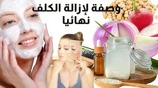 وصفاتي السرية لي القضاء على الكلف اول مرة على اليوتيوب وصفة طبيعية وفعالة 100/100