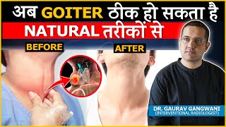 How To Cure Goiter/Thyroid Lump Without Surgery ? | Dr. Gaurav Gangwani (Interventional Radiologist)