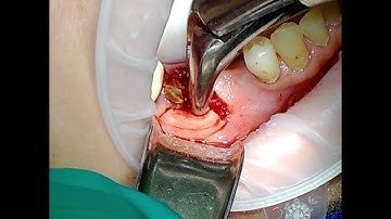 Molar Extraction with Sectioning and Socket Preservation with LPRF And Sticky Bone