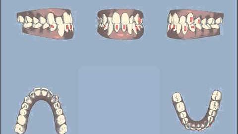 Invisalign ClinCheck Video - Toronto Invisalign Orthodontist Dr. Jason Tam