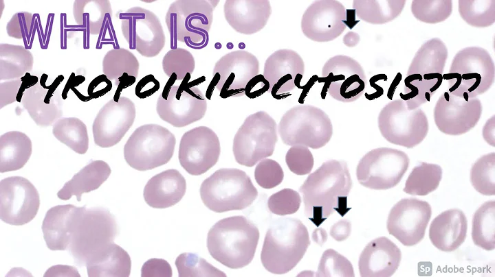 What is Pyropoikilocytos...  Peripheral Blood Smea...