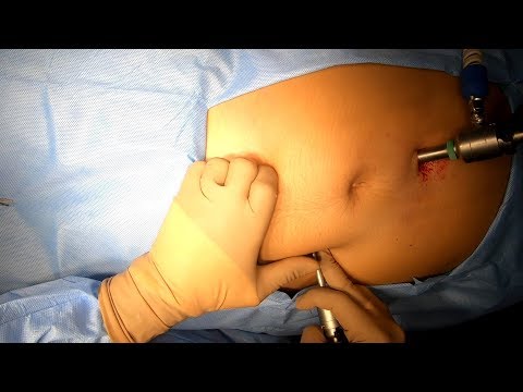 Video: Hernia Garis Putih Perut - Rawatan, Penyingkiran Dari Anak, Pembedahan