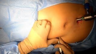 A sliding hiatus hernia is when the junction between the oesophagus and the stomach, as well as a po. 