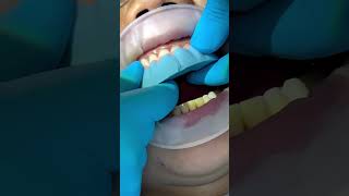 🦷 **Why Are Veneer Temporaries Essential?** 🦷 (Read Description) #veneers #temps #dentist 🦷 **Why Are Veneer Temporaries Essential?** 🦷 (Read Description) #veneers #temps #dentist