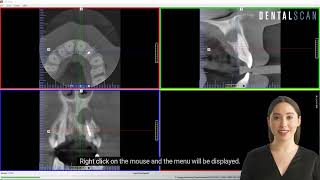 Icat Vision Tutorial Mpr Screen For Endo