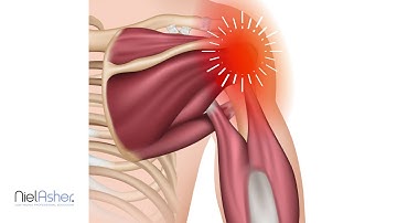 Teres Minor - Trigger Point Anatomy