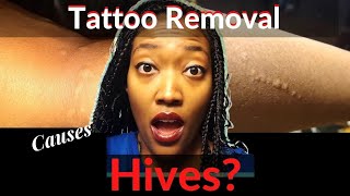 Tattoo removal and hives | Can this treatment be causing your sudden rashes? Maybe