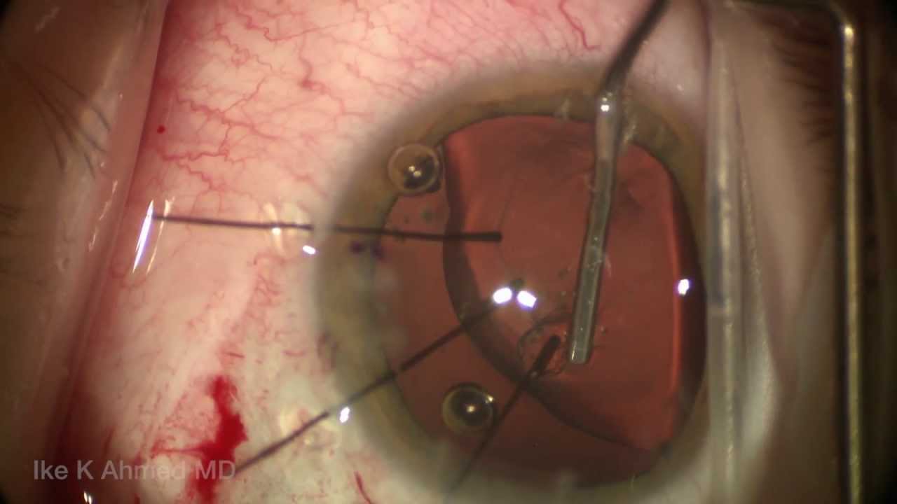 Capsular tension ring - American Academy of Ophthalmology