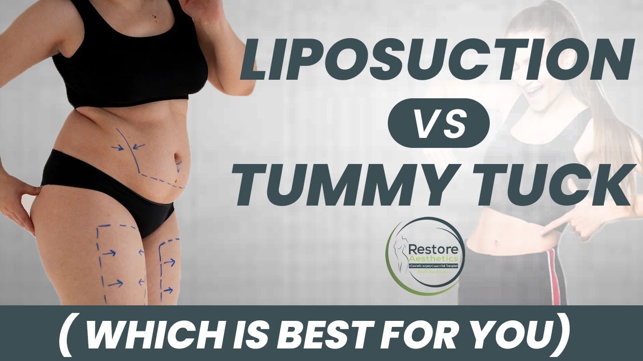 Liposuction vs Tummy Tuck  Benefits of Tummy Tuck Surgery