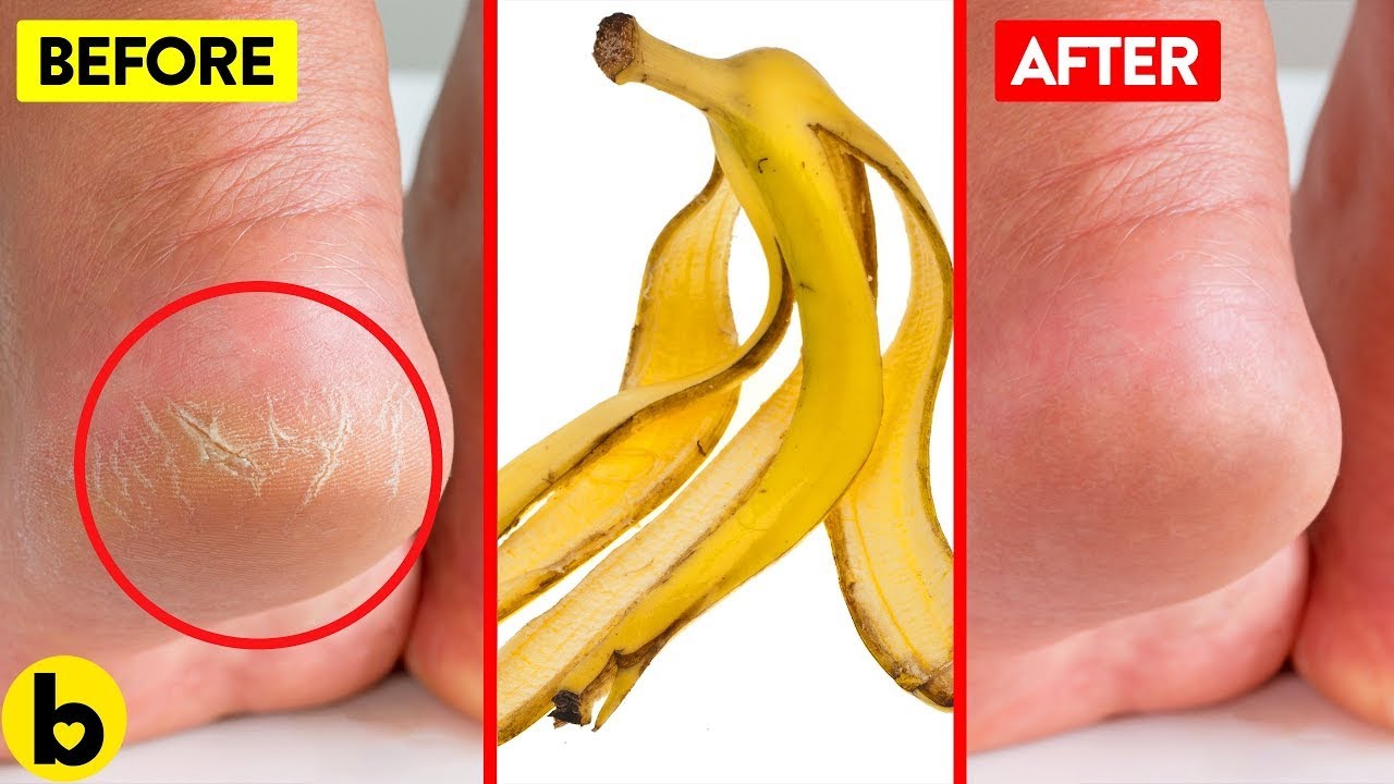 Here's How To Treat Cracked Heels At Home | Femina.in