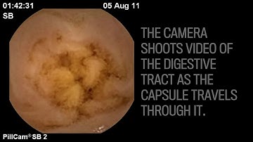 Capsule endoscopy: A tiny wireless camera through the digestive tract