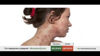 Видео Реакция организма на водку в форме аллергии (автор: Клиника "Московский Доктор")