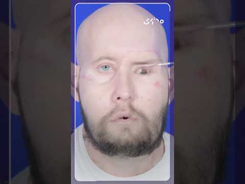 نجاح أول عملية زراعة عين في العالم 