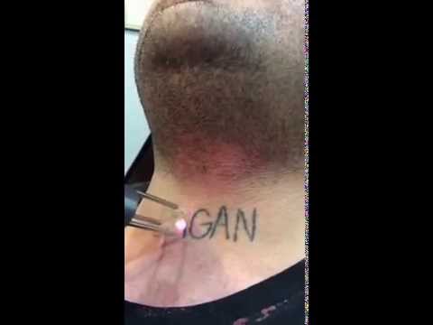 neck tattoo removal best tatto 2017 neck tattoo removal best tatto 2017