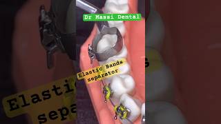 Elastic Bands , Separators Braces , Orthodontics