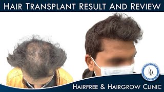 Hair Transplant Best Result and Review (in Gujarati) | By Dr. Richa Sanmukhani Ahmedabad Clinic