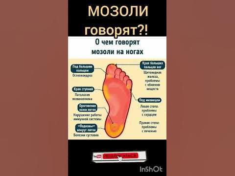 Говорящие мозоли. #здоровье #долголетие #польза #стройность #мозоли # ...