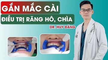 Quy trình gắn mắc cài niềng răng điều trị răng hô, chìa tại nha khoa italiano Thái Nguyên