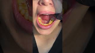 Prevent Caries with Povidone Iodine placement through Povi-one by Hygiene Edge 2,883 views 1 month ago 1 minute, 48 seconds