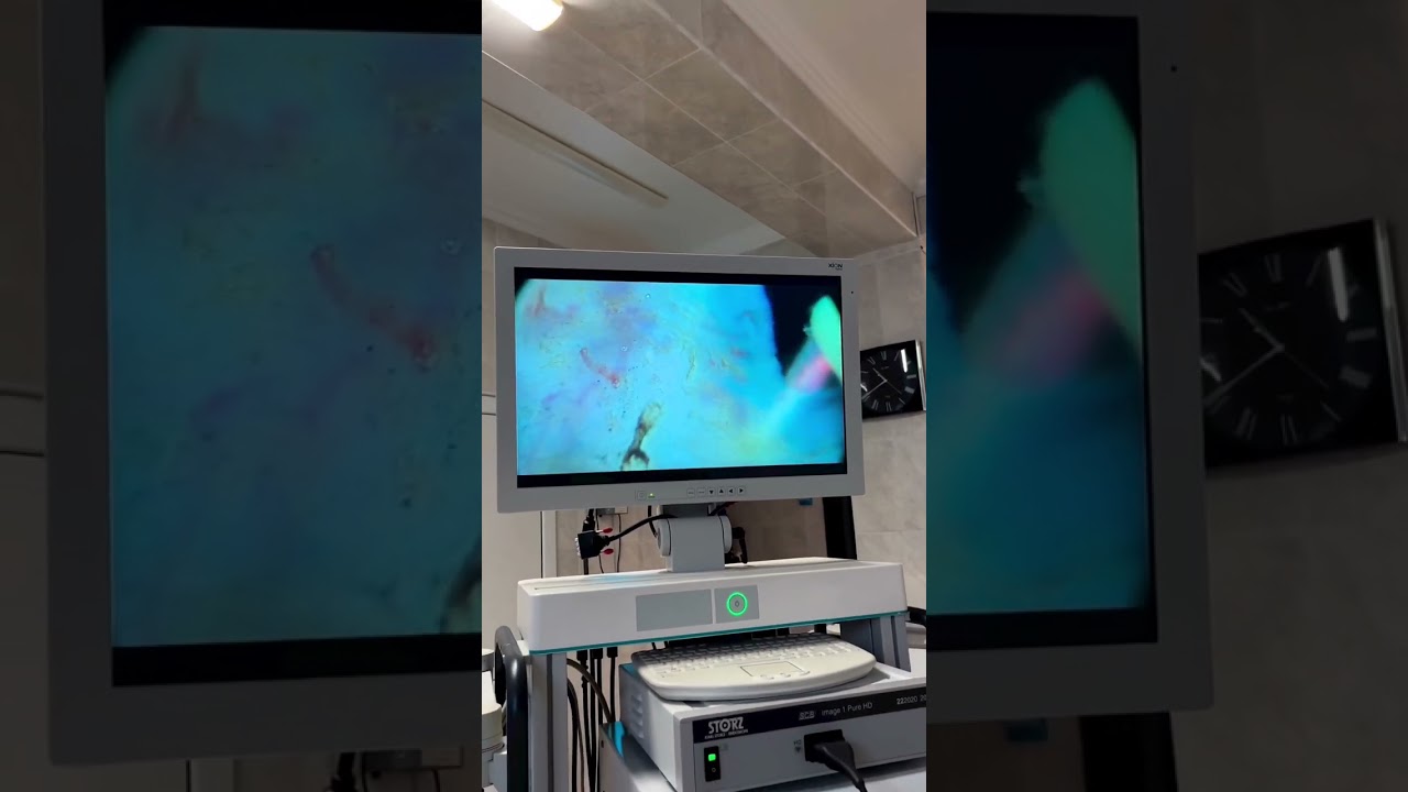 Трансуретральная резекция простаты