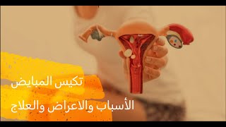 تكيس المبايض السبب الرئيسي وطرق العلاج