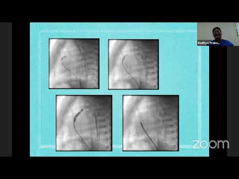 approach of pulmonary atresia fot nurse