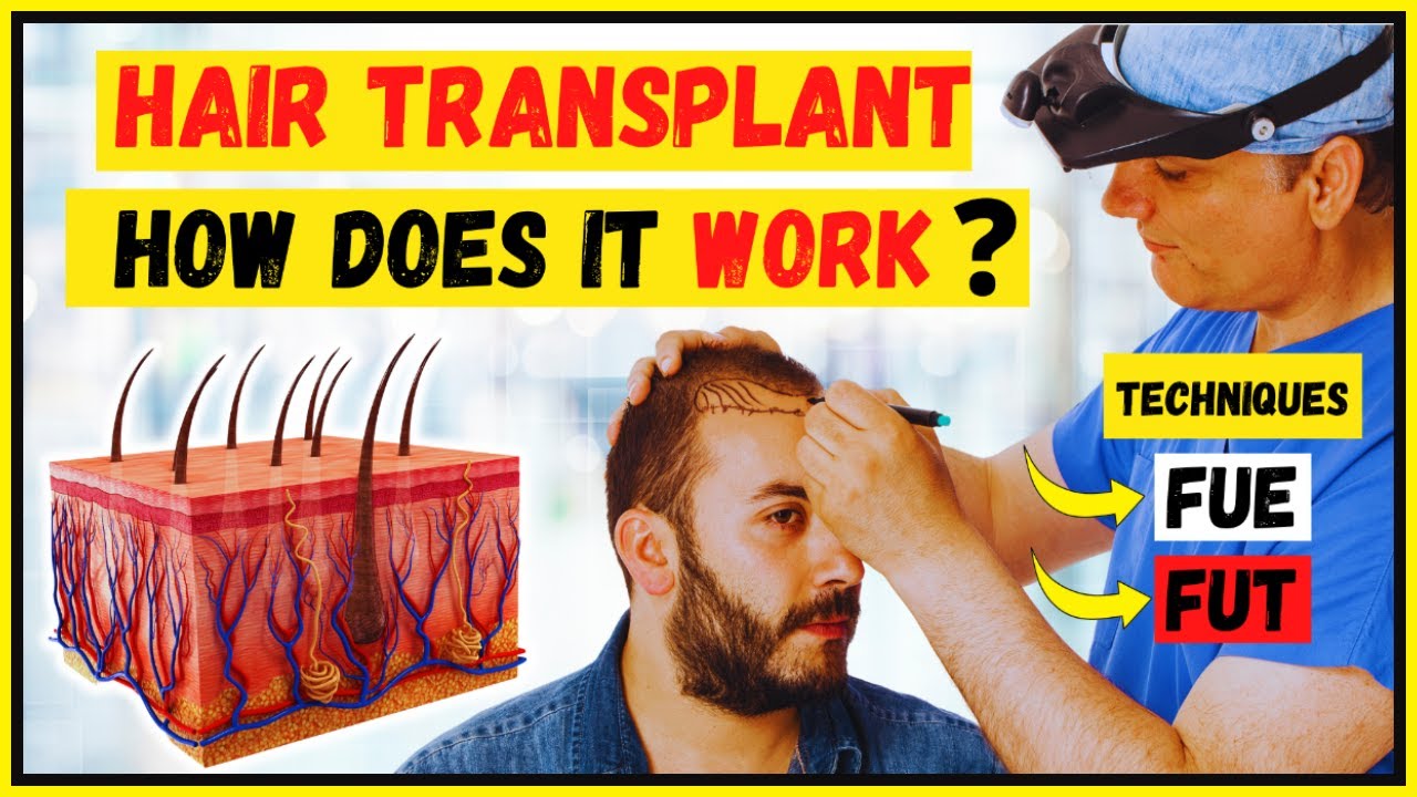 How hair transplant works animation? FUE and FUT difference and hair