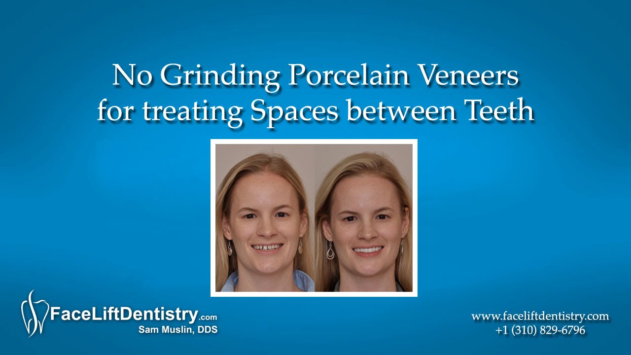 No Grinding Porcelain Veneers for treating Spaces between Teeth cosmetic dentistry grants program