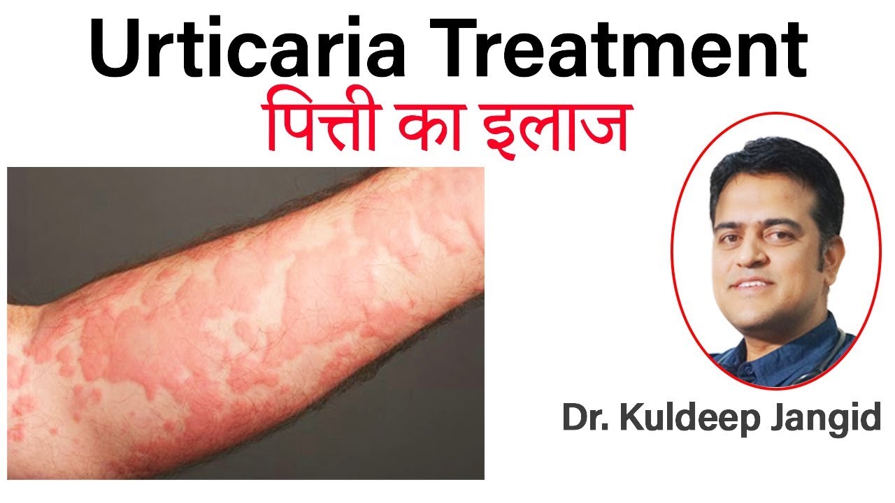 Best treatment of Urticaria Hives best treatment चकत्तों का इलाज