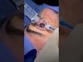 cirurgia Refrativa PRK 7,5 miopia com astigmatismo, já levanta enxergando!!! É D+!!!!!