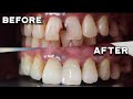 FRONT TEETH FILLING | PASTA SA HARAPANG NGIPIN | Doc Noy