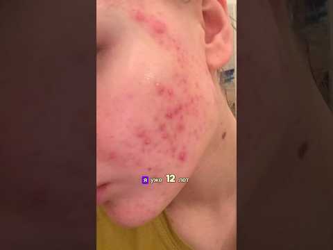 АКНЕ, как я победила😖😱 #акне #кожа #уход #уходзакожей #здоровье #красота #beauty #прыщи