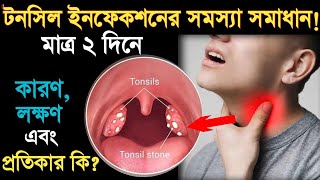 টনসল ইনফকশন এর করণ,লকষণ ও করণয- এর পরতকর ক? Tonsillitis Symptoms-Tonsillitis Home Remedies.
