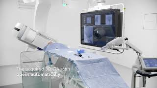 Download Lagu Simplifying and advancing 3D imaging with SmartCT in aneurysm flow diverter MP3