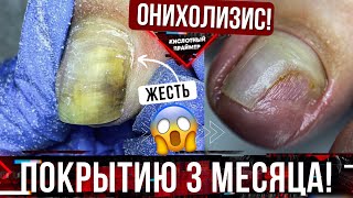 СНОВА ОНИХОЛИЗИС ногтей🙈 3 МЕСЯЦА покрытию‼️😱 Причины онихолизиса, что с этим делать🙏