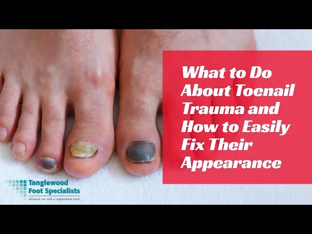 How to Treat an Ingrown Toenail Without Surgery - YouTube