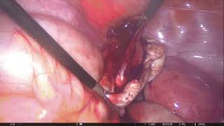 Endometriozis (Çikolata Kisti ) ameliyatı_ laparoskopik_ Ankara