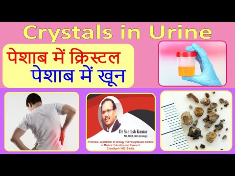 Crystals in urine. पेशाब में खून | पेशाब में क्रिस्टल. Dr.(Prof)Santosh Kumar PGI.