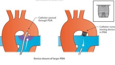 PDA device closure   #heart #congenitalheartdefects #congenitalheartdisease