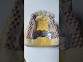 Протезирования бюгельные и металлокерамически зубов поэтапно clasp dentures with metal ceramics
