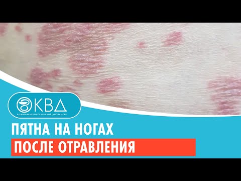 🦵🦵 Пятна на ногах после отравления. Клинический случай №818