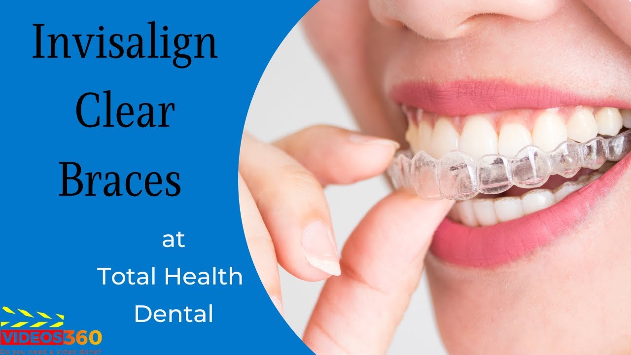 Invisalign Aurora IL - Clear Aligners for Teeth Straightening