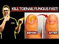 10 BEST Natural Toenail Fungus Home Remedies!