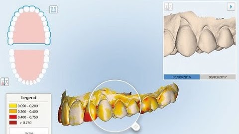 Dr. Rafi Romano- iTero TimeLapse