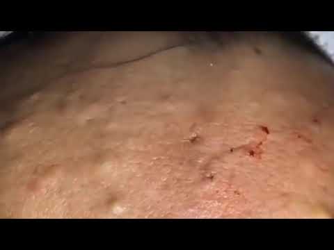 HUGE CYSTIC ACNE EXTRACTION