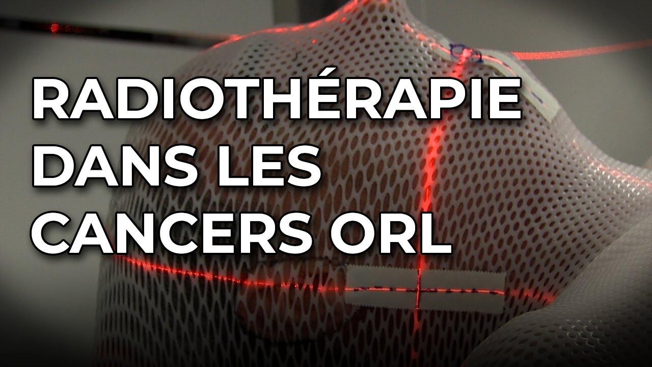 Radiothérapie dans la prise en charge des cancers ORL