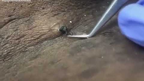 [ LÔNG MỌC NGƯỢC TẠO THÀNH CỤC U NANG MỤN  VÀ CÁI KẾT ]