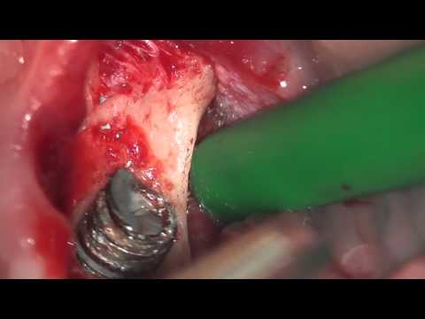 Video: Vanzemaljski Implantati - Alternativni Prikaz