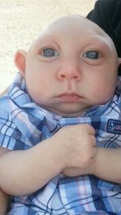 Мальчик родившийся без мозга как выглядит сейчас Boy born with MISSING brain defies huge odds to live after 'it GREW back' The