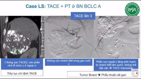 Chẩn đoán và điều trị ung thư đường tiêu hóa